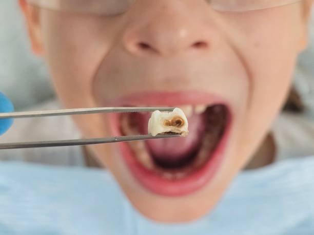 Emergency Dentist for Kids in CO